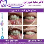 اصلاح طرح لبخند