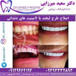 لبخند هالیوودی