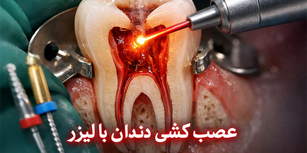 کاندید عصب کشی با لیرز
