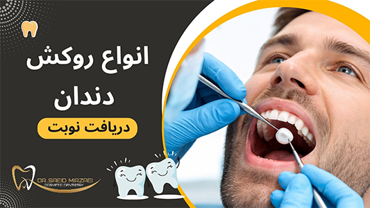 انواع روکش دندان چیست