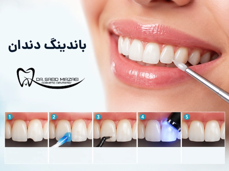 باندینگ دندان
