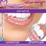 بعد از لمینیت دندان