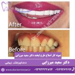 اصلاح طرح لبخند