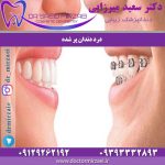 مراحل انجام ارتودنسی