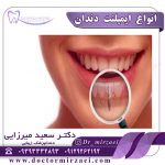 انواع-ایمپلنت-دندان