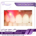 جراحی لثه با لیزر