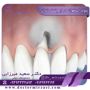پیوند استخوان در ایمپلنت دندان