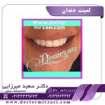 لمینت دندان