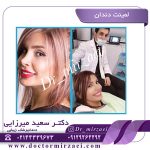 مراقبت بعد از لمینت دندان