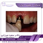 ماندگاری ایمپلنت دندان