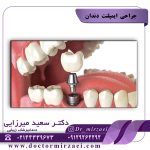 جراحی ایمپلنت دندان