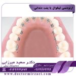 ارتودنسی لینگوال یا پشت دندانی