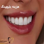 هزینه بلیچینگ دندان