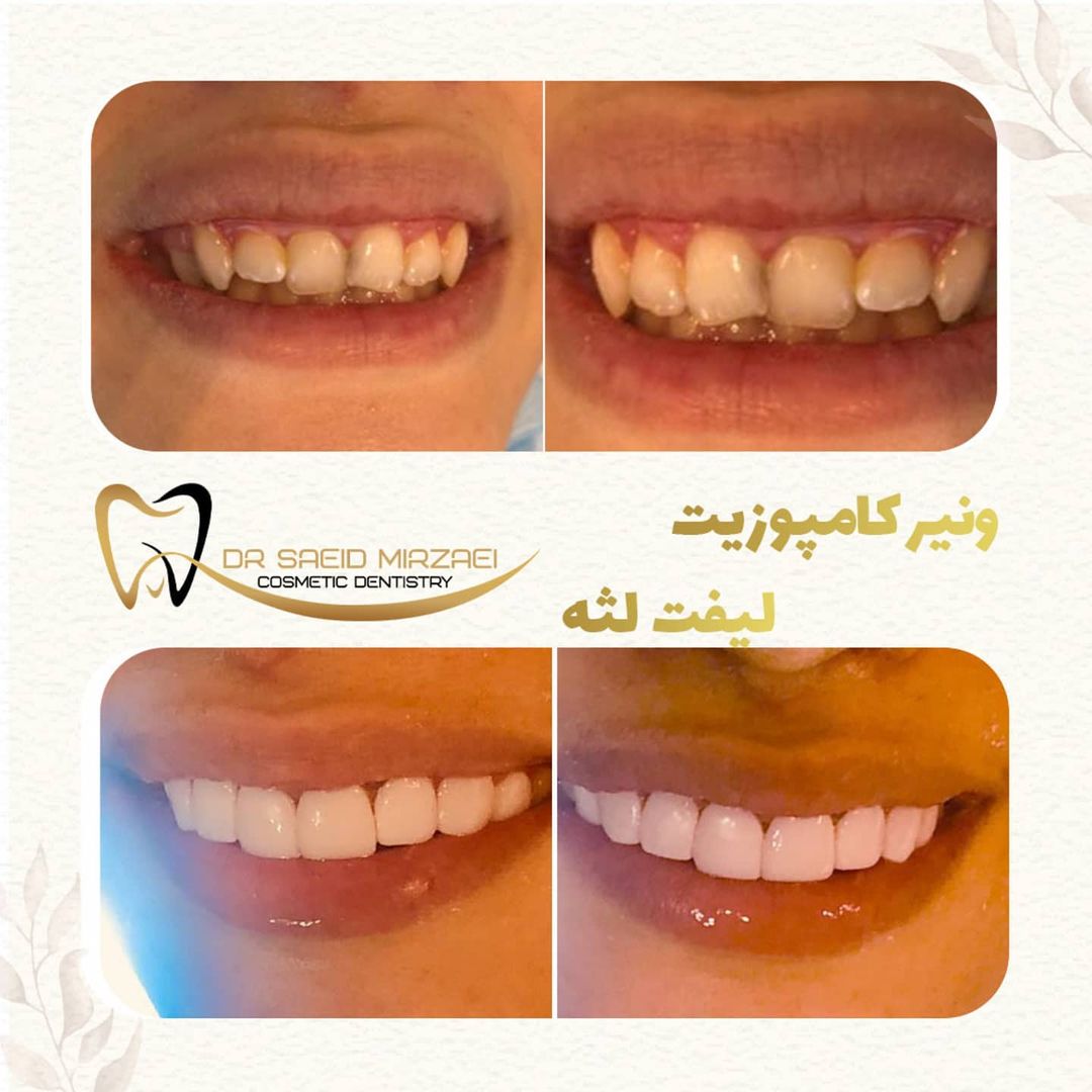 نمونه کار زیبایی دندان 17