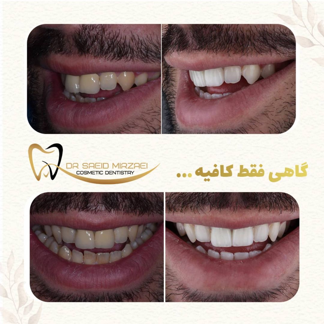 نمونه کار زیبایی دندان 9