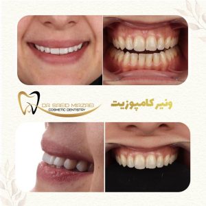 کامپوزیت ونیر دکتر میرزایی