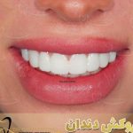 لمینت دندان دکتر میرزایی
