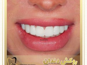 لمینت دندان دکتر میرزایی