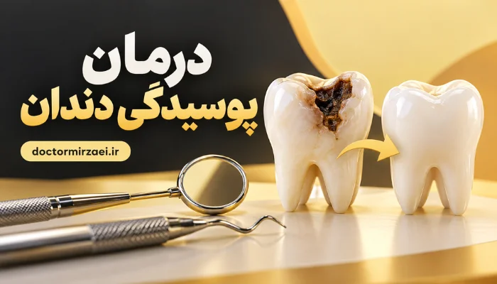درمان پوسیدگی دندان و ترمیم دندان پوسیده برای بازگرداندن سلامت دندان