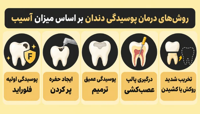 روشهای درمان پوسیدگی دندان بر اساس میزان آسیب؛ فلورایدتراپی، پرکردن، ترمیم، عصبکشی و روکش