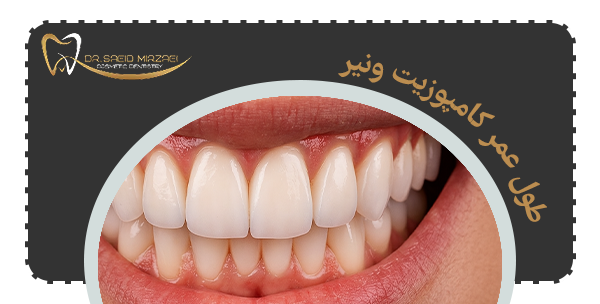 طول عمر کامپوزیت ونیر چقدر است