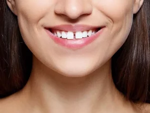 انواع درمان ها برای دندان های فاصله دار