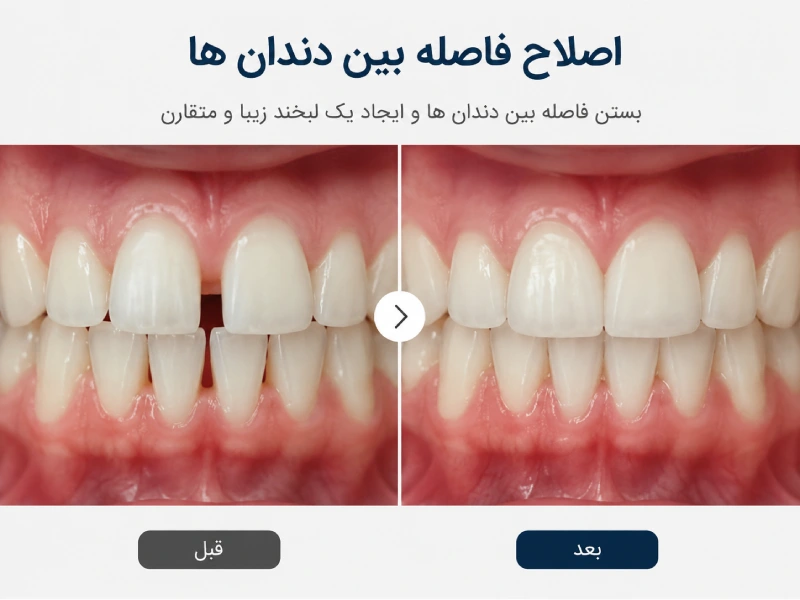 بستن فاصله بین دندان ها