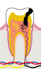 مرحله چهارم پوسیدگی دندان