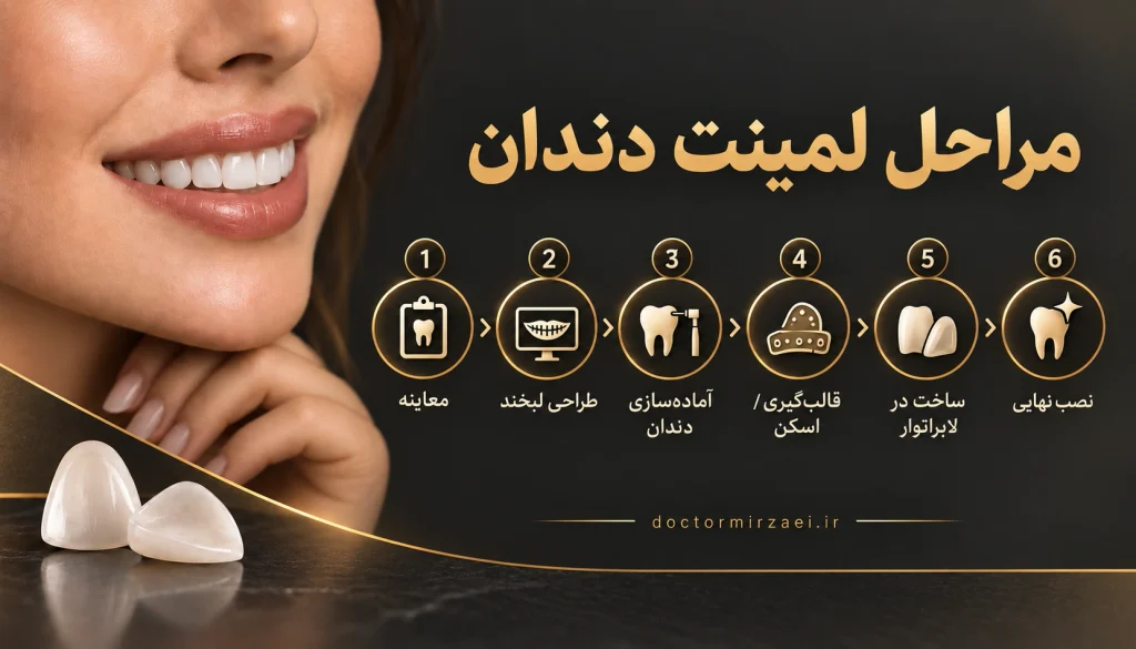 چه کسانی کاندید مناسب لمینت دندان هستند
