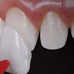 مرحله سوم لمینت دندان