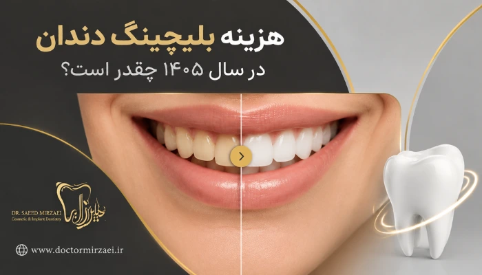 هزینه بلیچینگ دندان در 1405