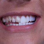 برداشت لمینت