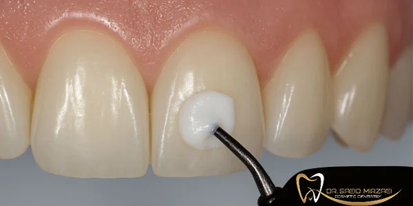 عوارض کامپوزیت بر دندان