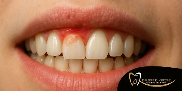 عوارض کامپوزیت بر لثه