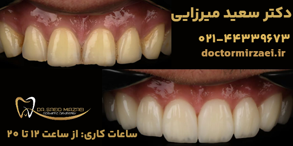 نمونه کار کامپوزیت دندان