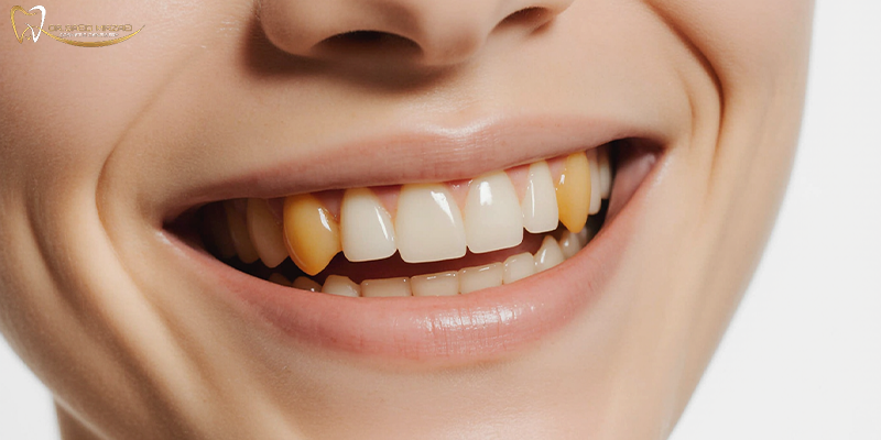 تاثیر قهوه و چایی بر دندان کامپوزیت