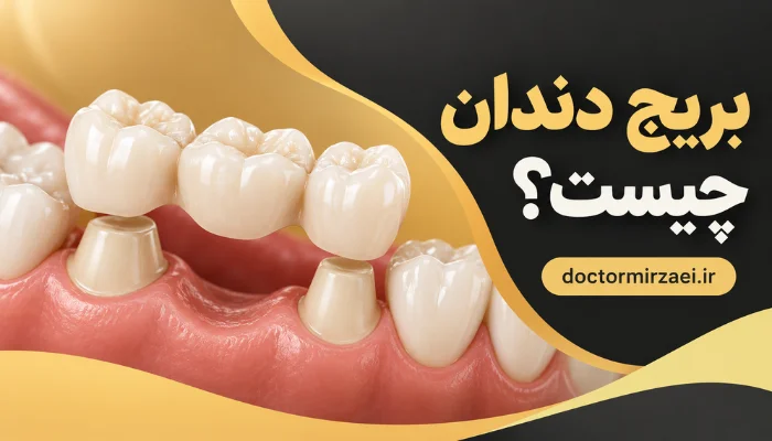 بریج دندان برای جایگزینی دندان از دست رفته