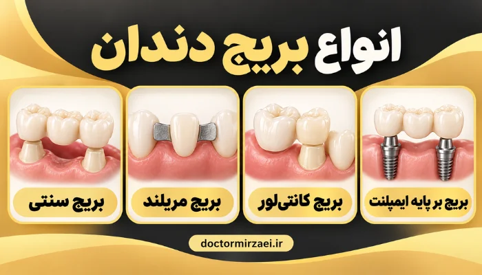 انواع بریج دندان شامل سنتی، مریلند، کانتیلور و بریج بر پایه ایمپلنت