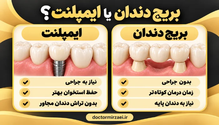 مقایسه بریج دندان و ایمپلنت برای جایگزینی دندان از دست رفته