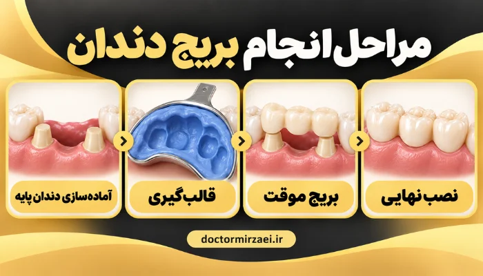 مراحل انجام بریج دندان از آمادهسازی دندان پایه تا نصب نهایی