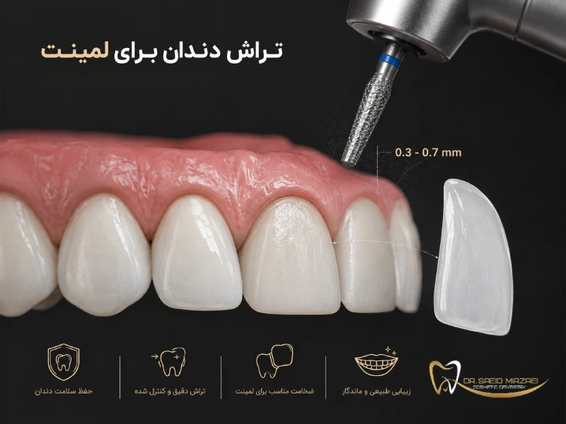 تراش دندان ها برای لمینت